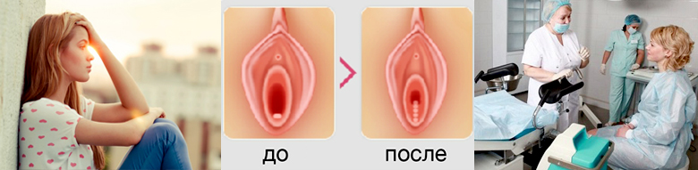 Операция по восстановлению девственности